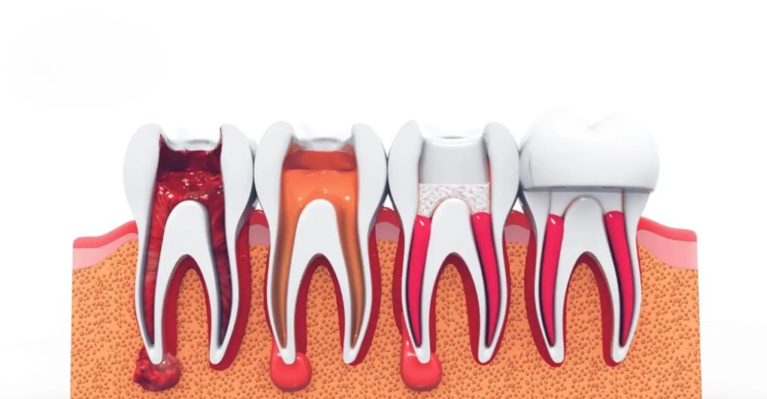 Root Canal Procedure Diagram 2